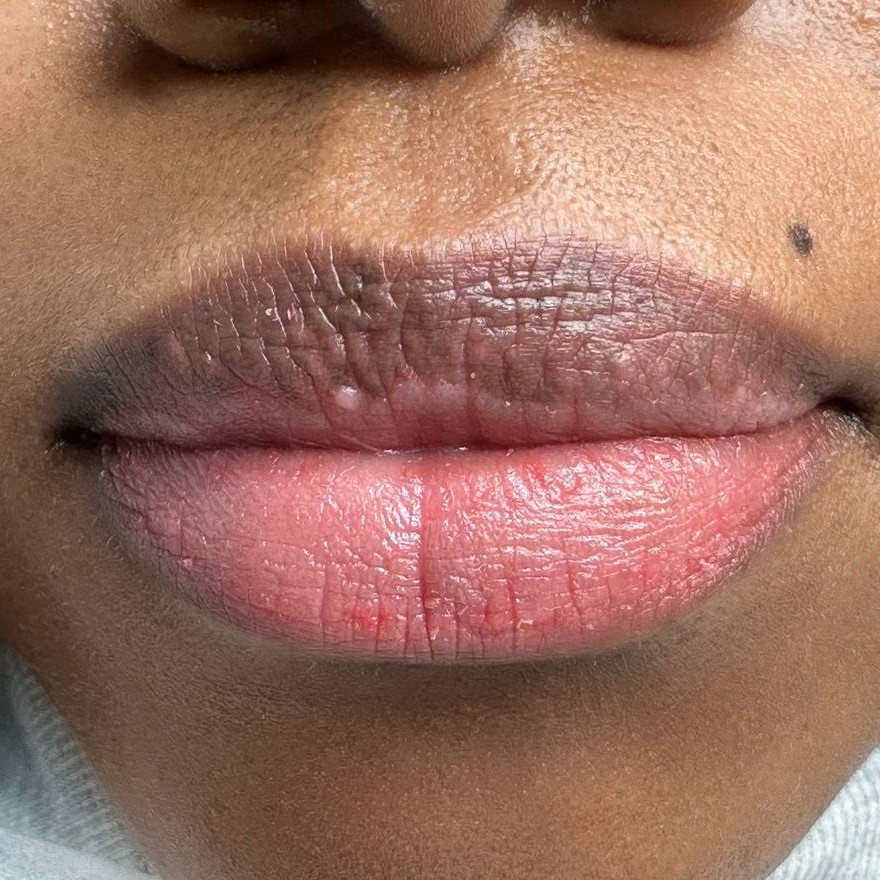 Lip Neutralization result at Bacani Atelier Vienna